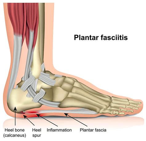 Plantar Fasciitis