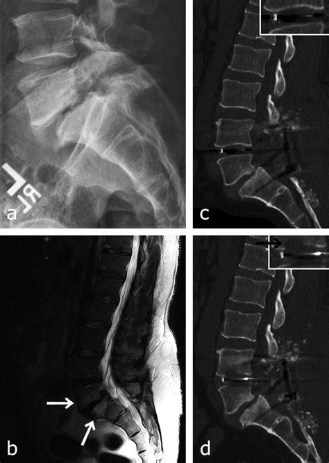 Case 3. Preoperative lateral X-ray (a) reveals L5 spondylolysis and... | Download Scientific Diagram