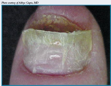 what is toenail fungus home remedy