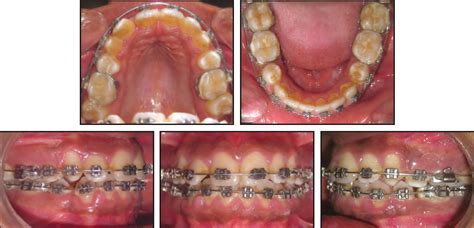 Gradual Grinding of a Talon Cusp During Orthodontic Treatment - JCO ...