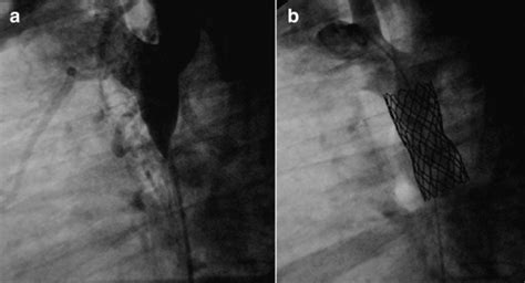 Aortogram in lateral position showing a severe CoA with near atresia.... | Download Scientific ...