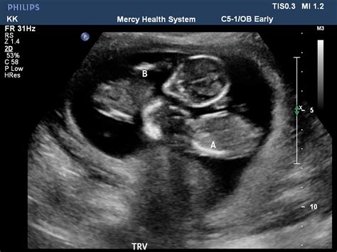 Ultrasound Pictures Of Identical Twins