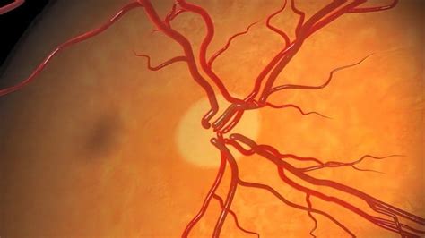 What Causes Optic Nerve Damage? | Eye Diseases & Conditions