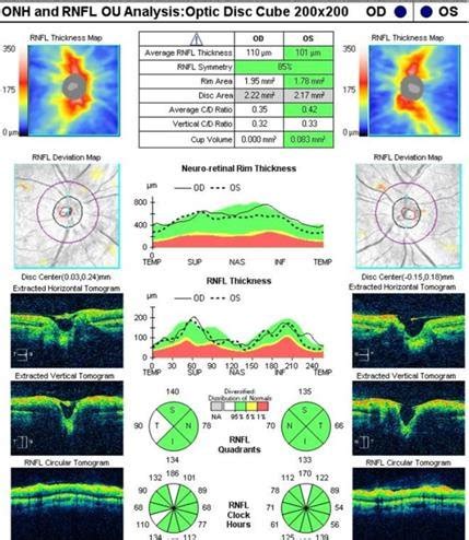 OCT-Optic disc analysis in both eyes after 3 months | Download ...