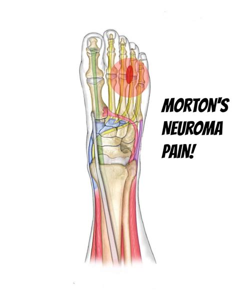 1000+ images about Morton's Neuroma on Pinterest | The long, Massage and Morton's neuroma