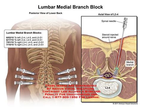 Pin on Medial Branch Block