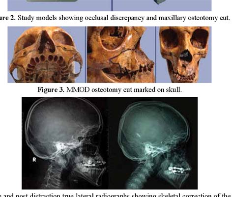 Figure 3 from II A case of maxillary hypoplasia with cleft lip and palate corrected using Mid ...