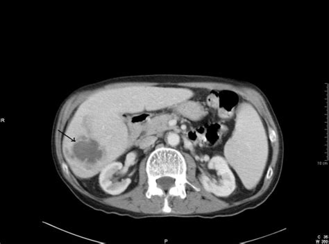 CT scan demonstrating several ill-defined low attenuation lesions with ...