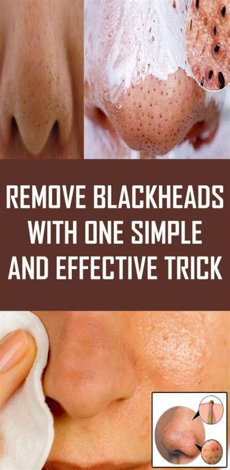 Sensitive Skin and How to Treat Blackheads - Rijal's Blog