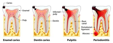 Root Canal Procedure | Dental Associates