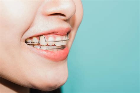 Permanent Retainers - Pros, Cons, & Costs