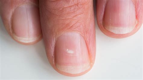 Do you have white marks on your fingernails? This is what they mean ...