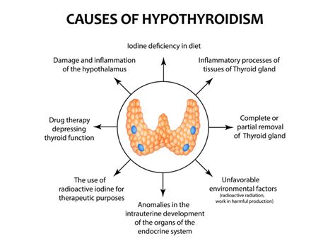 What Is Hypothyroidism, and Is It Treatable? - HealthProAdvice