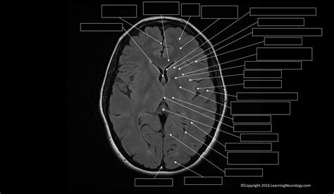 Brain Mri Labeled