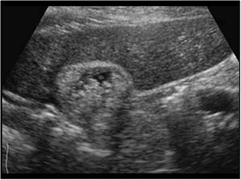 Abdomen and retroperitoneum | 1.2 Gallbladder and bile ducts : Case 1.2.10 Gallbladder ...