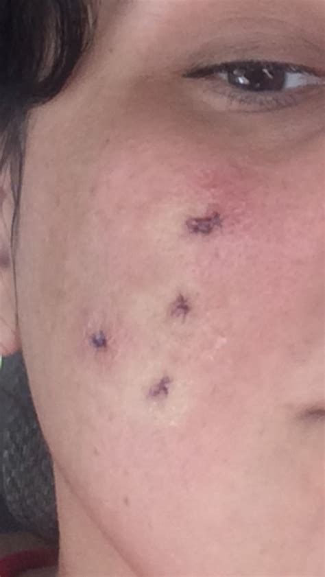 Acne Scar Excision – Scar treatments – Acne.org Forum