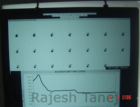 Paediatric urology: Refluxing ectopic (Vaginal) ureter - Dr Rajesh Taneja