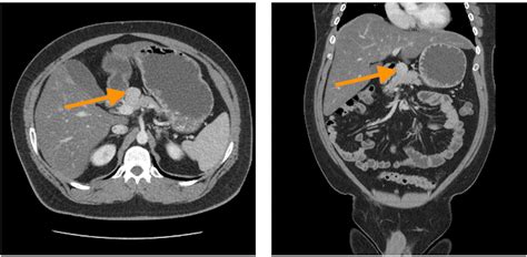 Clinical Pathology Glossary: Gastrinoma & Zollinger-Ellison Syndrome ...