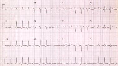 Junctional Tachycardia