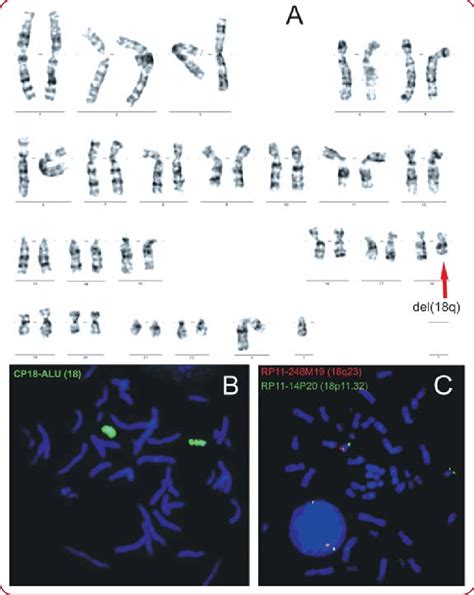 Cytogenetic results for the patient: A. GTG-banded karyotype... | Download Scientific Diagram