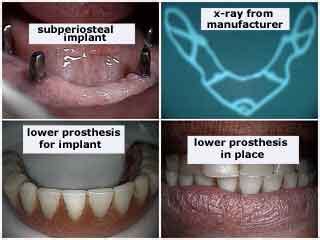 Subperiosteal dental implants and hybrids