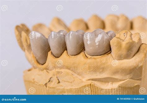 Ceramic dental implants stock photo. Image of orthodont - 74145950