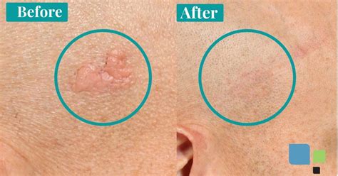 Should I Have Mole Removal on My Face? (Before and After Photos) – Primera Plastic Surgery