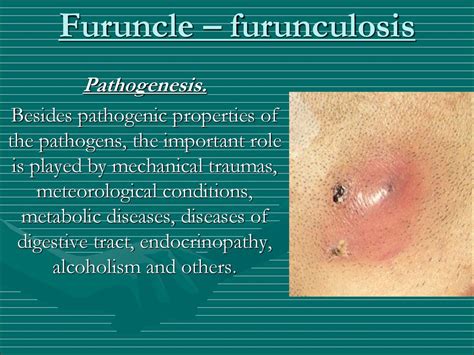 Furuncle Meaning