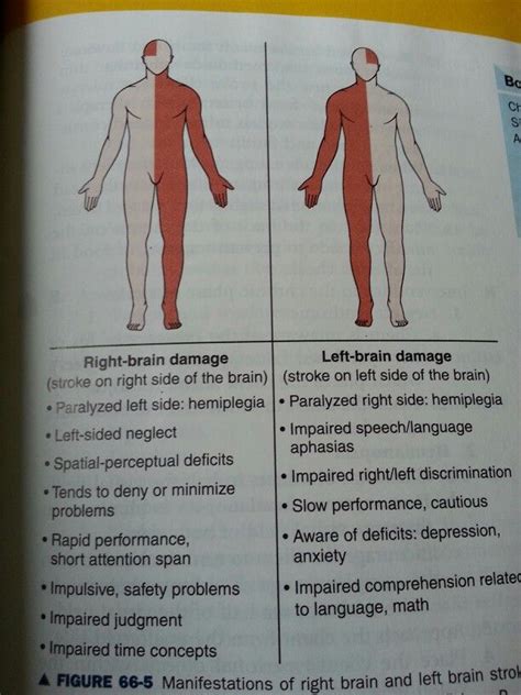 Right vs left sided stroke | Stroke nursing, Medical school studying ...