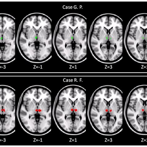 Bilateral thalamic damage detectable on T1-weighted images of the two ...