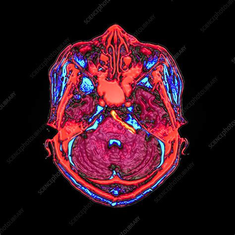 MRI Brain Scan of Deformed Brainstem - Stock Image - M170/0346 ...