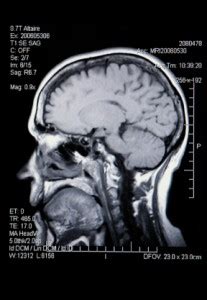 Closed Head Injuries | Traumatic Brain Injury | Ginsberg Law