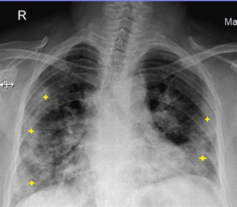 Cureus | Treatment With Remdesivir in Two Pregnant Patients With COVID-19 Pneumonia