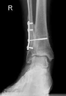 Understanding The Biomechanics Of Equinus