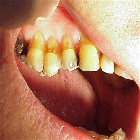 The Signs And Symptoms Of Toothbrush Abrasion | Registered dental hygienist, Dental health ...