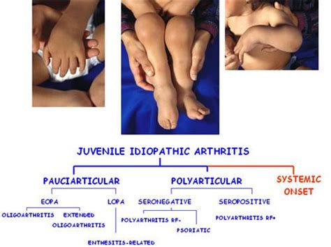 types-of-juvenile-arthritis-symptoms.jpg (500×375) #juvenilearthritis #whatisjuvenilearthritis ...