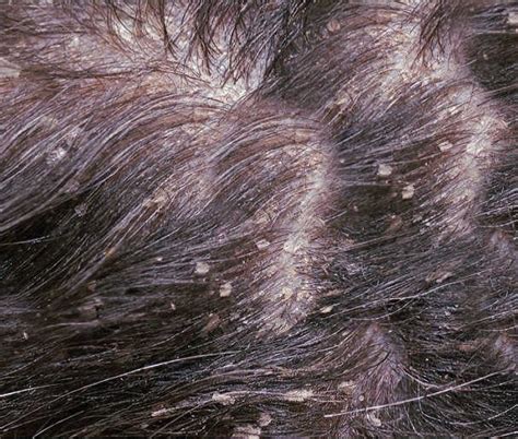 What Is Walking Dandruff On Dogs