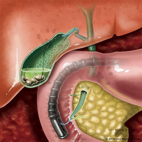 Endoscopic gallbladder stenting procedure