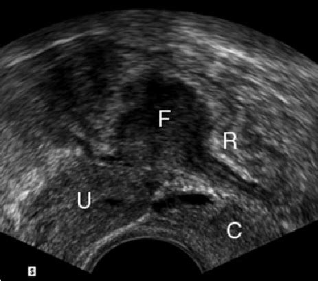 Transvaginal sonography showing occlusion of the Douglas pouch due to... | Download Scientific ...