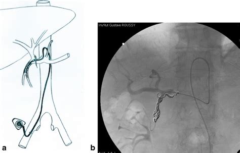 Percutaneous intra-arterial catheter placement. Drawing (a) and ...