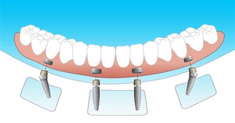 Know Procedure of Full Mouth Treatment in Detail : r/Dentistry