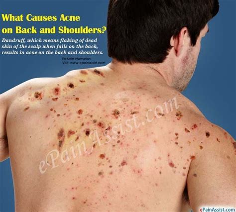 What Causes Acne on Back and Shoulders? | Chest acne, How to treat acne ...