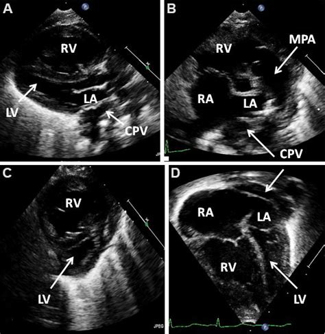 Selected video frames of a 2-dimensional echocardiogram in parasternal ...