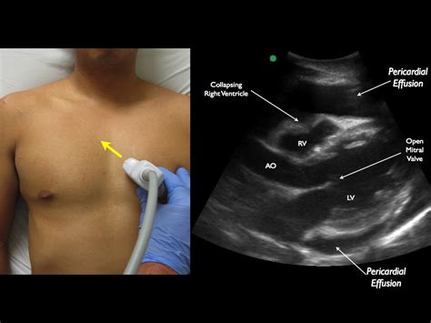 PERICARDIOCENTESIS — Highland EM Ultrasound Fueled pain management