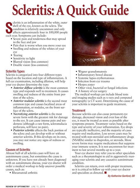 Episcleritis Vs Scleritis