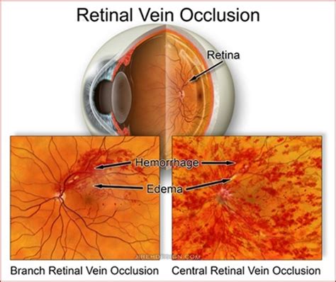 Branch Retinal Vein Occlusion - Information on Eye Conditions