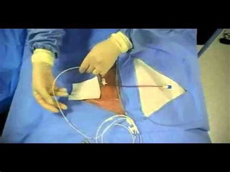 Simple Cardiology: - Insertion of Transvenous Pacemaker.