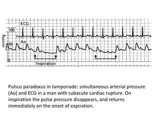 Pericardial Tamponade | PPT