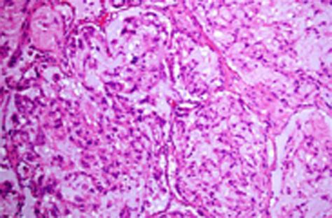 Epithelioid Hemangioendothelioma