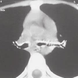 a. Full face graphy showing maxillary hypoplasia, hypoplastic small... | Download Scientific Diagram